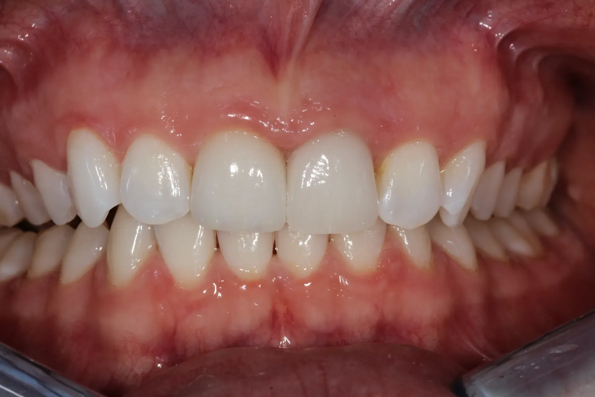 After treatment