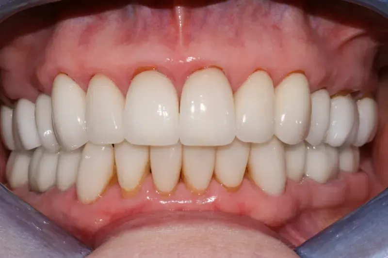 After treatment